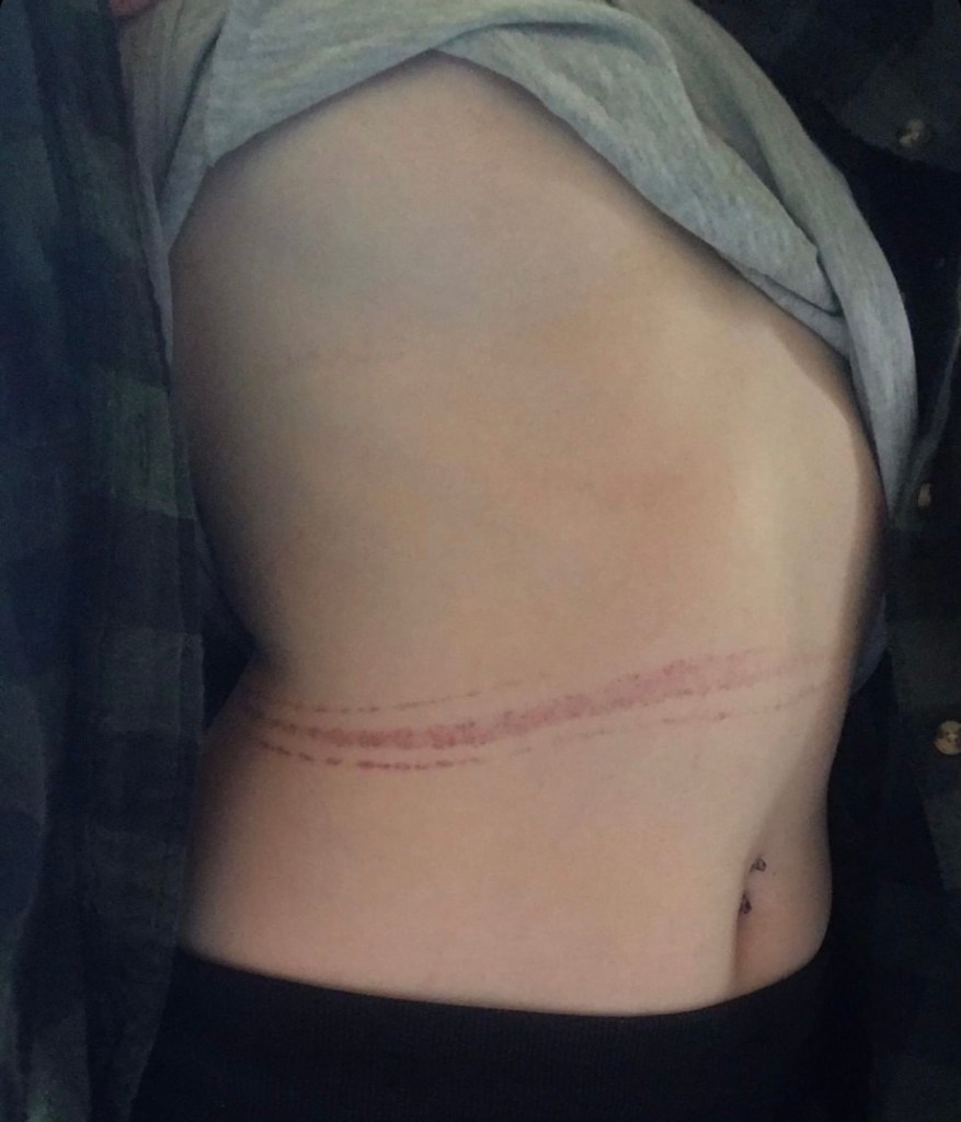 Petechial hemorrhaging left behind after a tie